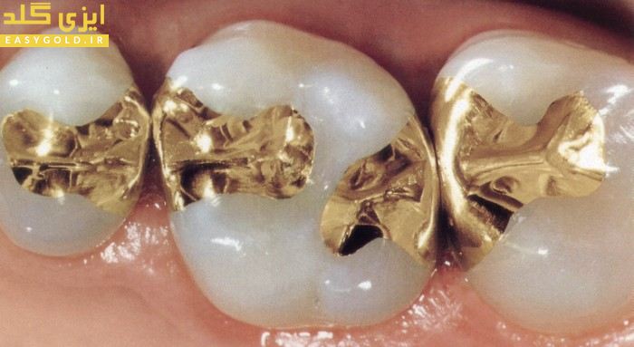 بازیافت طلا از ضایعات دندانسازی