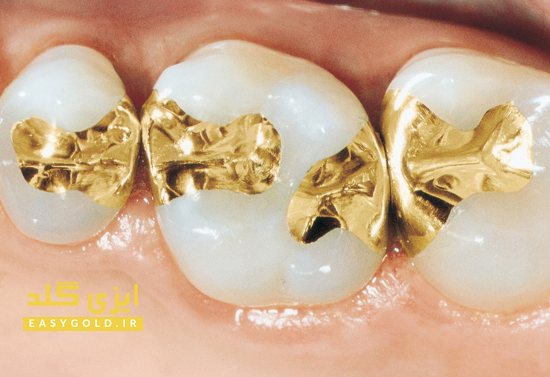  طلا در دندانپزشکی